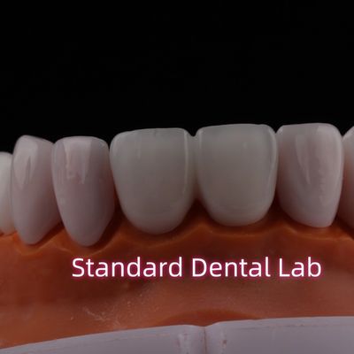 Mua Tranlucent Emax Zirconia Laminate Veneers Porcelain Dental Veneers Chất hóa học sản xuất trực tuyến