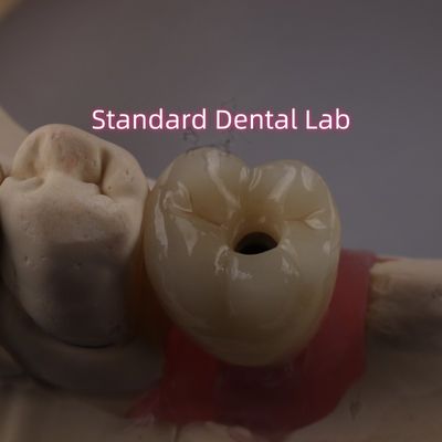 Mua Vít giữ cấy ghép răng vương miện PFZ Porcelain lớp Zirconia sản xuất trực tuyến