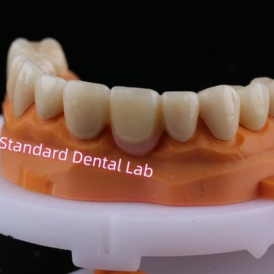 Mua Digital CAD CAM Milling Layered Zirconia Bridge Crown với đồ sứ màu hồng sản xuất trực tuyến