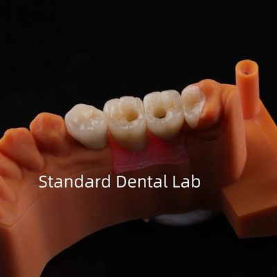 Mua Porcelain Zirconia Dental Implant Bridge chuyên nghiệp thẩm mỹ cao sản xuất trực tuyến