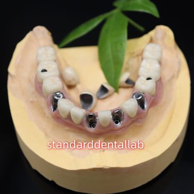 Mua Vít giữ cấy ghép răng kim loại vương miện gốm Malo cầu sản xuất trực tuyến