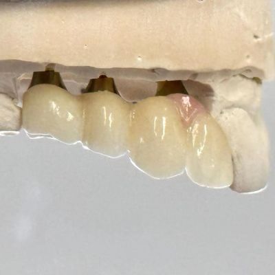 Mua Porcelain Zirconia Cement giữ lại cấy ghép vít hình dạng đầu hình lục giác cho thẩm mỹ phù hợp tùy chỉnh sản xuất trực tuyến