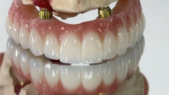 Mua Nha khoa tất cả trên X cấy ghép PFM vương miện Titanium cố định Hybrid răng giả sản xuất trực tuyến