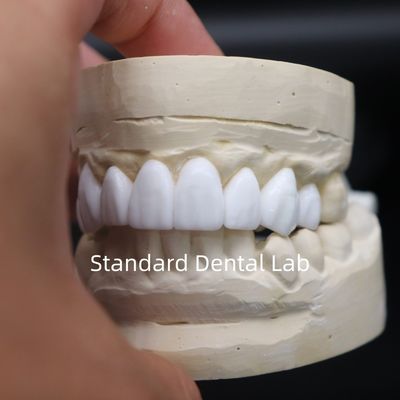 Mua Vương miện nha khoa chẩn đoán sáp lên thẩm mỹ cao từ Trung Quốc phòng thí nghiệm nha khoa sản xuất trực tuyến