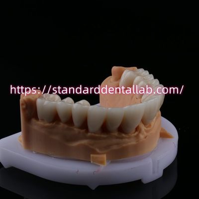 Mua FDA cao thẩm mỹ răng Zirconia cây cầu với lớp sứ Zirconia vương miện răng Trung Quốc Phòng thí nghiệm nha khoa sản xuất trực tuyến