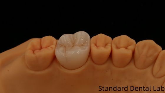 Mua Noritake Porcelain Full Contour Zirconia Crown Customized Vita Shade cho phục hồi răng kỹ thuật số thẩm mỹ bởi Phòng thí nghiệm nha khoa sản xuất trực tuyến