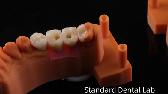 Mua Vòng tròn cấy ghép răng được giữ lại bằng vít với lớp kim cọ PFZ Zirconia 5 năm và mô hình in 3D sản xuất trực tuyến