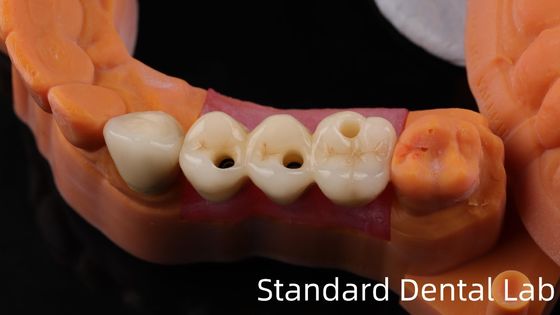 Mua Các chuyên gia Zirconia răng cấy ghép Vương miện Titanium CAD CAM Zirconia Vương miện Trung Quốc Phòng thí nghiệm nha khoa sản xuất trực tuyến