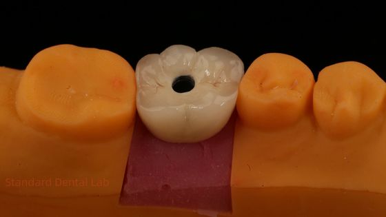 Mua Vòng vít giữ lại PFZ Porcelain Layered Zirconia Vương miện cấy ghép răng từ Phòng thí nghiệm nha khoa ISO FDA CE được chứng nhận với bảo hành 5 năm sản xuất trực tuyến