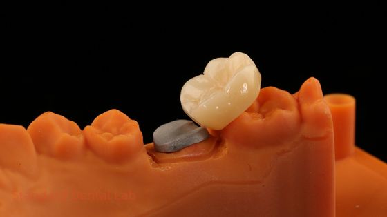 Mua Cao thẩm mỹ Full Contour Zirconia vương miện với Metal Post Core 5 năm bảo hành và kỹ thuật viên tốt hơn từ SDL phòng thí nghiệm nha khoa sản xuất trực tuyến