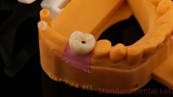 Mua Vít cấy ghép răng giữ vương miện PFZ Porcelain Layered Zirconia With 3D Print Model sản xuất trực tuyến
