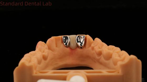 Mua Nha khoa PFM Maryland Bridge thẩm mỹ cao FDA được chứng nhận với Vita Porcelian Trung Quốc phòng thí nghiệm nha khoa sản xuất trực tuyến