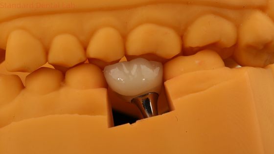 Mua Vòng vít giữ răng Implant Vương miện răng PFM Vương miện răng với mô hình in 3D sản xuất trực tuyến