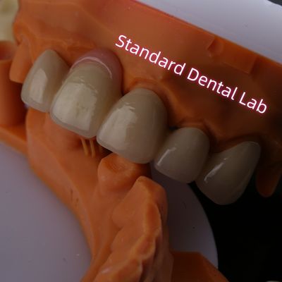 Tương thích sinh học cao PFZ Porcelain Layered Zirconia With Pink Gum