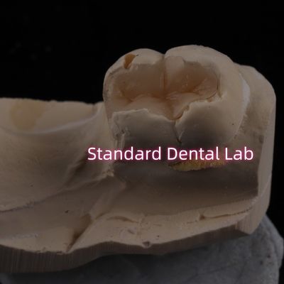 Đổ đồ sứ răng Inlay Onlay Overlay Zirconia Emax Esthetics cao