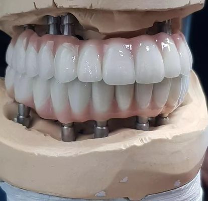 Precision-Crafted Zirconia Implant Screw Cement được giữ lại cho răng trông tự nhiên