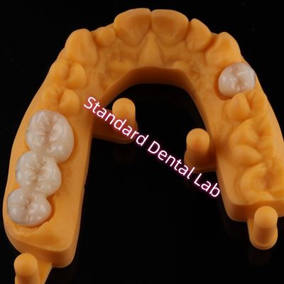 Vương miện tất cả đồ sứ gốm Zirconia Ivoclar răng thẩm mỹ OEM