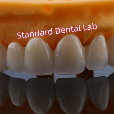 Phục hồi mặt trước Vương miện cây cầu Zirconia cho răng bị mất