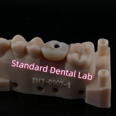 Custom Abutment Implant Crown Full Contour Zirconia Screw giữ lại