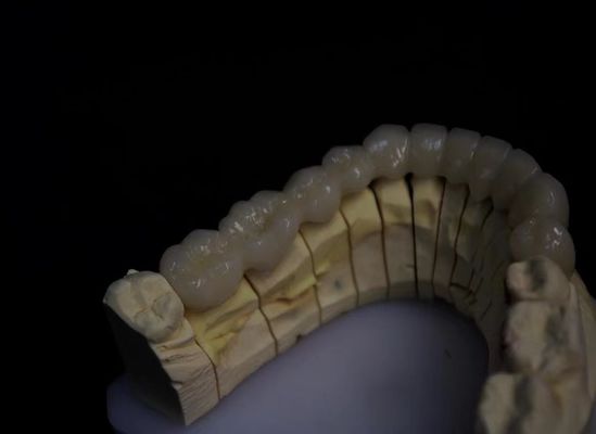 Lớp sứ kim loại Zirconia