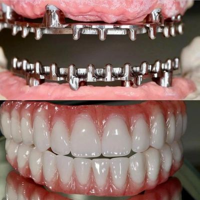 Dental Hybrid Malo Implant Bridge chuyên nghiệp hoàn hảo phù hợp FDA chứng nhận