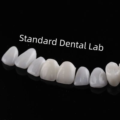 Răng thẩm mỹ cao Emax Laminate Veneers Incisal Translucency