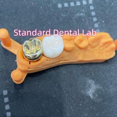 Vương miện hợp kim vàng không quý Full Cast With Zirconia Crown