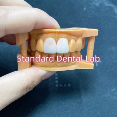 Độ ổn định màu cao Ivoclar Emax Laminate Veneers Độ xuyên suốt cao