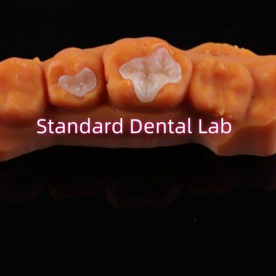 Đồ sứ nha khoa Inlay Onlay Overlay Zirconia Emax Composite Cho răng sâu