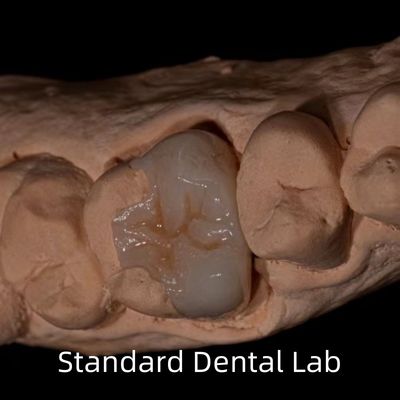 Xanh Emax Zirconia răng Inlay Onlay vương miện để khôi phục hình dạng khoang tự nhiên