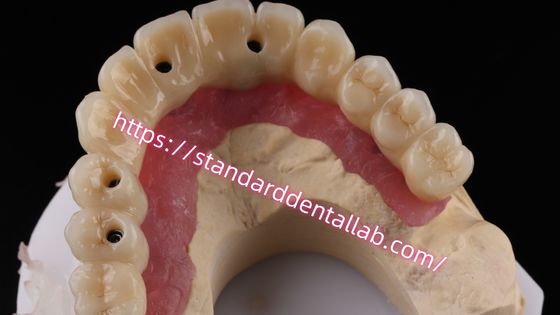 Multilayer Zirconia Screw giữ cây cầu cấy ghép tương thích sinh học trên cấu trúc kim loại