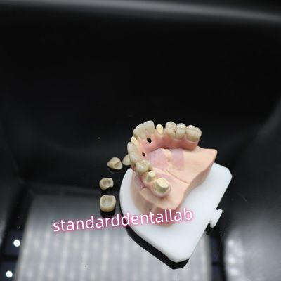 Đường cầu cấy ghép Malo răng số Titanium Ivoclar Hybrid Zirconia