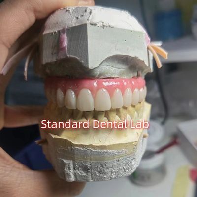 Vít giữ Titanium PMMA Dental Bridge Temporary Crown