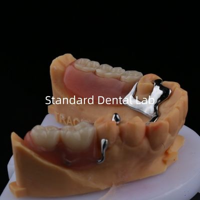 Hợp kim kim loại phần răng giả khung 3 hình dạng Exocad in laser thấp hơn đúc phần kết thúc