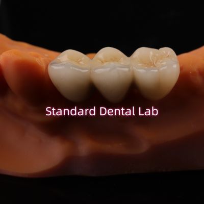 CAD CAM kỹ thuật số Vương miện phòng thí nghiệm nha khoa Trò xuyên suốt Lớp vương miện Zirconia