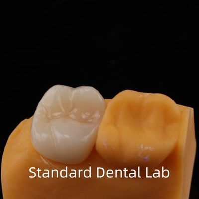 Bảo hành 5 năm Full Contour Zirconia Crown cho răng hàm răng Noritake Porcelain Made in by Trusted Dental Laboratory