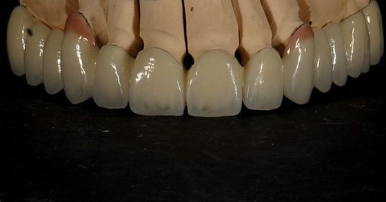 Tốt phù hợp tốt thẩm mỹ nhiều lớp Zirconia Crown Porcelain Zirconia Bridge