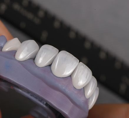 Emax Veneers trông tự nhiên Crown Biocompatibility Màu trắng với chuẩn bị tối thiểu