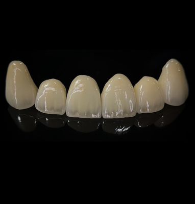 Vương miện Zirconia thoải mái với sự phù hợp tốt và thẩm mỹ chính xác