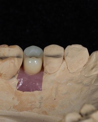 Cây cấy ghép giữ xi măng vít cho cấy ghép nha khoa lâu dài với bảo hành 5 năm