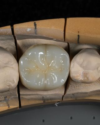 Full Contour Zirconia Crown Quick Turnaround cho sự phù hợp chính xác và thẩm mỹ trong 1 tuần