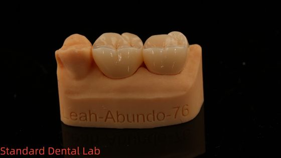 Vương miện phòng thí nghiệm nha khoa rắn 3D Pro Trò xuyên suốt cao Vương miện Zirconia đầy đủ với bảo hành 5 năm