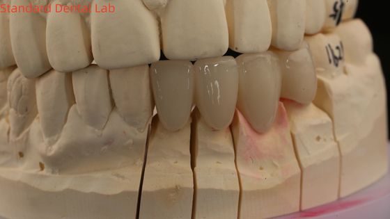 Vương miện phòng thí nghiệm nha khoa rắn 3D Pro Tấm xuyên suốt cao Vương miện Zirconia đầy đủ với màu Vita tùy chỉnh