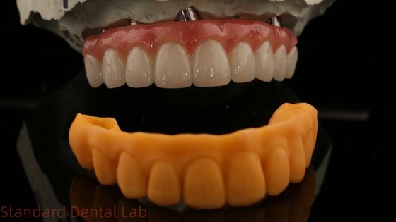 5 năm bảo hành cấy ghép răng Vương miện PMMA Bridge Over Multi Unit Abutments Tùy chỉnh Vita Shade