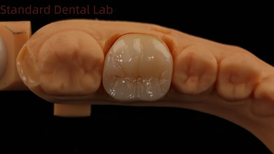 Mẫu in 3D nha khoa kỹ thuật số Full Zirconia Crown with Noritake Porcelain 5 năm bảo hành