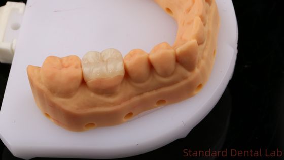 Đèn răng xuyên suốt Zirconia Onlay Crown để khôi phục hình dạng khoang tự nhiên / Phòng thí nghiệm nha khoa tiêu chuẩn