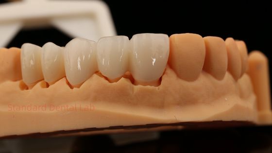 Mắt phía trước thẩm mỹ cao Full Contour Circonia Crown với phòng thí nghiệm nha khoa Vita Shade tùy chỉnh
