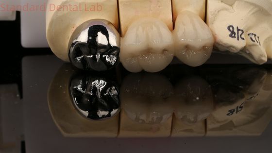 Vita Porcelain Full Metal Crown With Post Core 3 năm bảo hành từ phòng thí nghiệm nha khoa