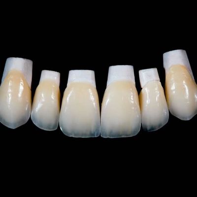 Cao độ xuyên suốt Emax Porcelain Veneers Crown với vật liệu tốt hơn bởi Ivoclar Vivadent