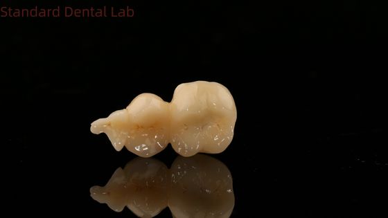 Nha khoa kỹ thuật số Full Zirconia Crown With 3D Print Model SDL Dental Lab Zirconia Onlay